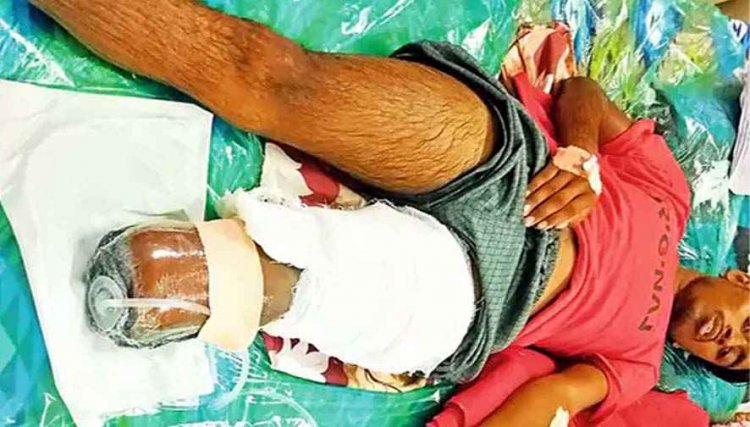 अंधविश्वास का खौफनाक अंजाम, सांप के डसने पर झाड़-फूंक के चक्कर में छात्र ने गंवाया पैर, क्रांतिकारी विचार मंच ने उठाई सख्त कार्रवाई की मांग